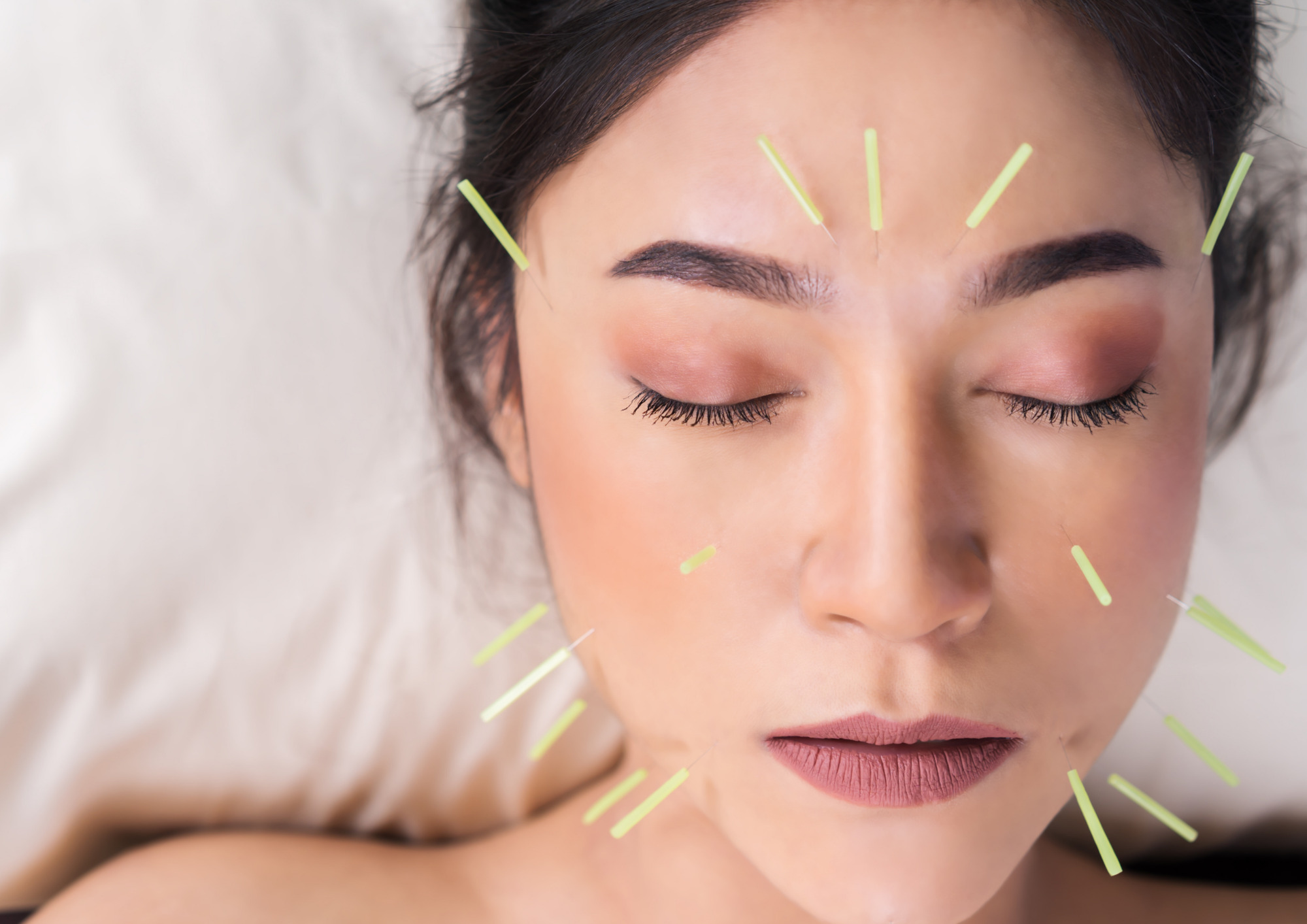 フェイスラインアップ！小顔を目指す方におすすめの美容鍼施術について【松山市】